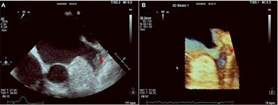 Preoperative diagnostic value of multimodal spectral CT for patients with atrial fibrillation undergoing radiofrequency ablation